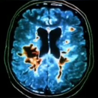РАССЕЯННЫЙ СКЛЕРОЗ | НЕВРОЛОГИЯ | МЕДИЦИНА | MULTIPLE SCLEROSIS | NEUROLOGY | MEDICINE